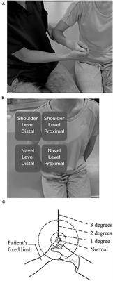 Validity and Reliability of the <mark class="highlighted">Semmes-Weinstein Monofilament</mark> Test and the Thumb Localizing Test in Patients With Stroke